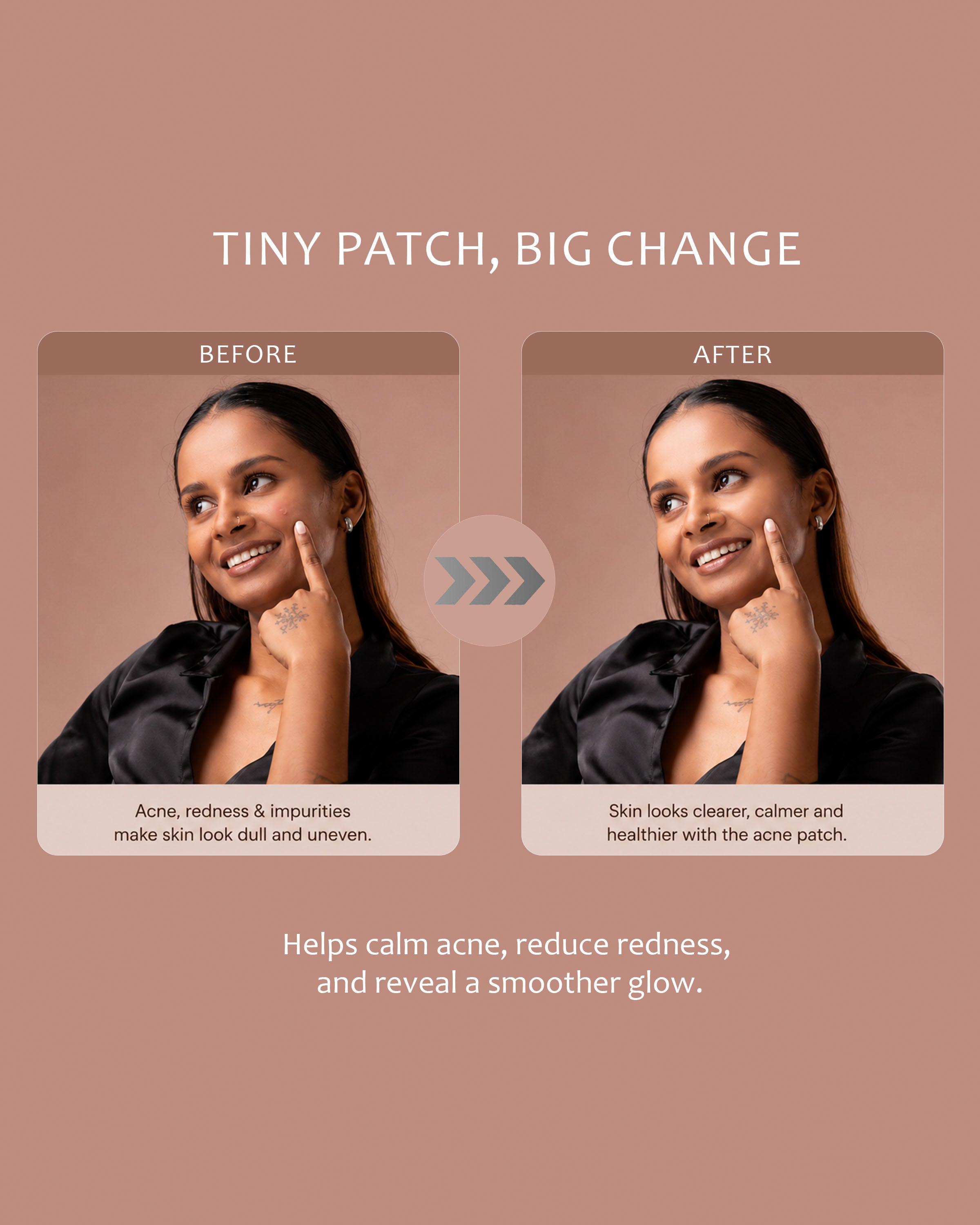 Acne patches